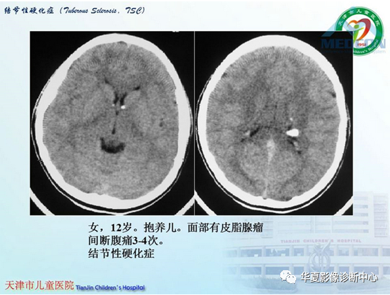 影像PPT - 【PPT】儿童常见神经皮肤综合征影像诊断-23