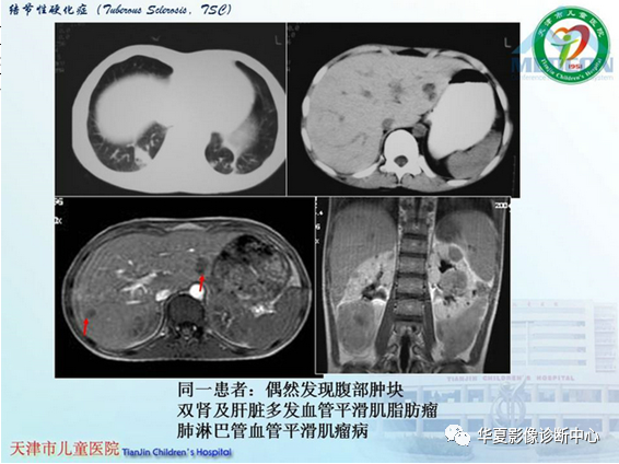 影像PPT - 【PPT】儿童常见神经皮肤综合征影像诊断-26