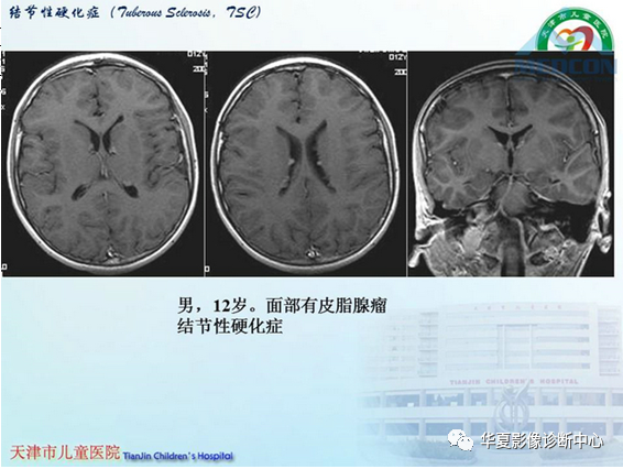 影像PPT - 【PPT】儿童常见神经皮肤综合征影像诊断-25