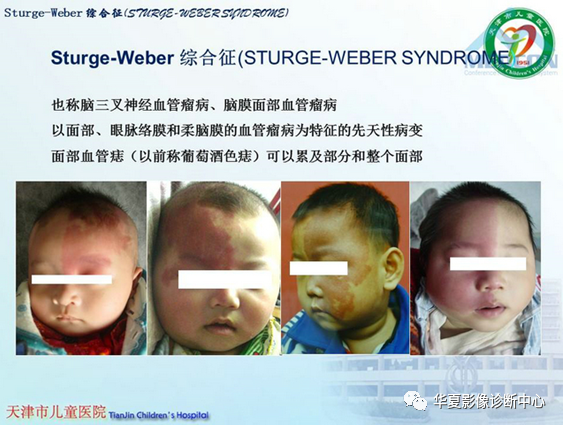 影像PPT - 【PPT】儿童常见神经皮肤综合征影像诊断-30