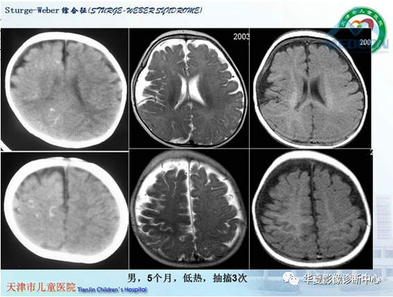 影像PPT - 【PPT】儿童常见神经皮肤综合征影像诊断-36
