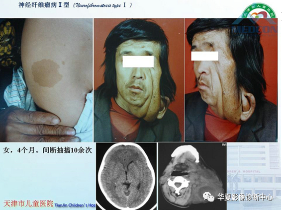 影像PPT - 【PPT】儿童常见神经皮肤综合征影像诊断-43