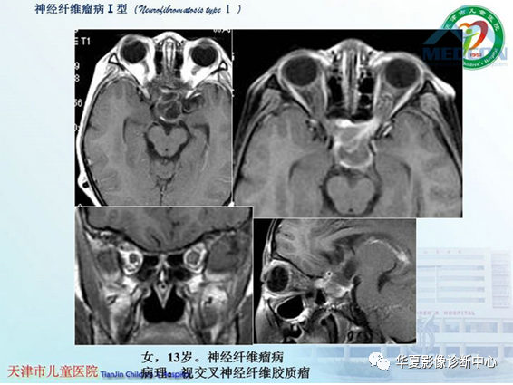 影像PPT - 【PPT】儿童常见神经皮肤综合征影像诊断-46