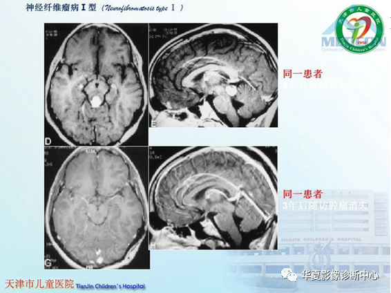 影像PPT - 【PPT】儿童常见神经皮肤综合征影像诊断-48