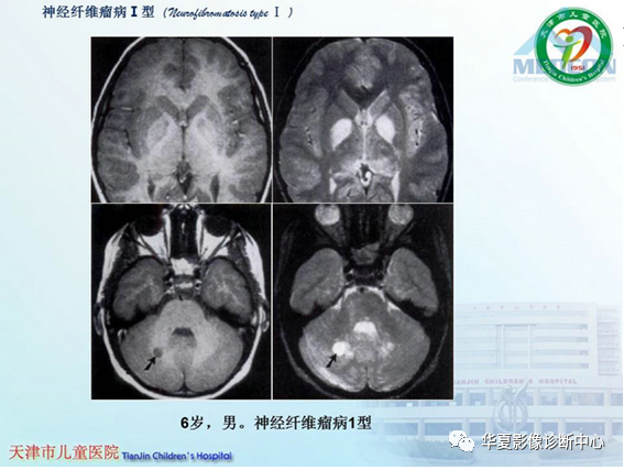 影像PPT - 【PPT】儿童常见神经皮肤综合征影像诊断-50