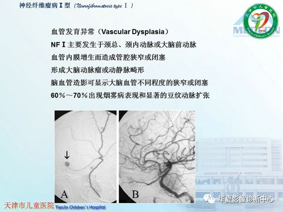 影像PPT - 【PPT】儿童常见神经皮肤综合征影像诊断-51