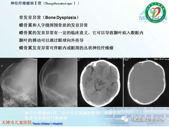 影像PPT - 【PPT】儿童常见神经皮肤综合征影像诊断-52