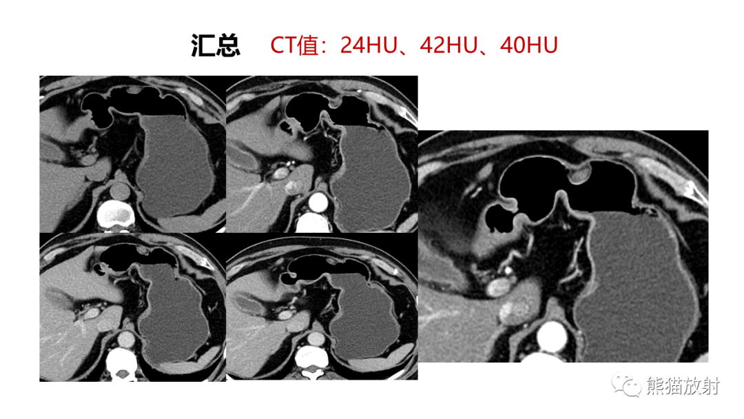 影像PPT - 【病例】异位胰腺2例CT及MR影像-4
