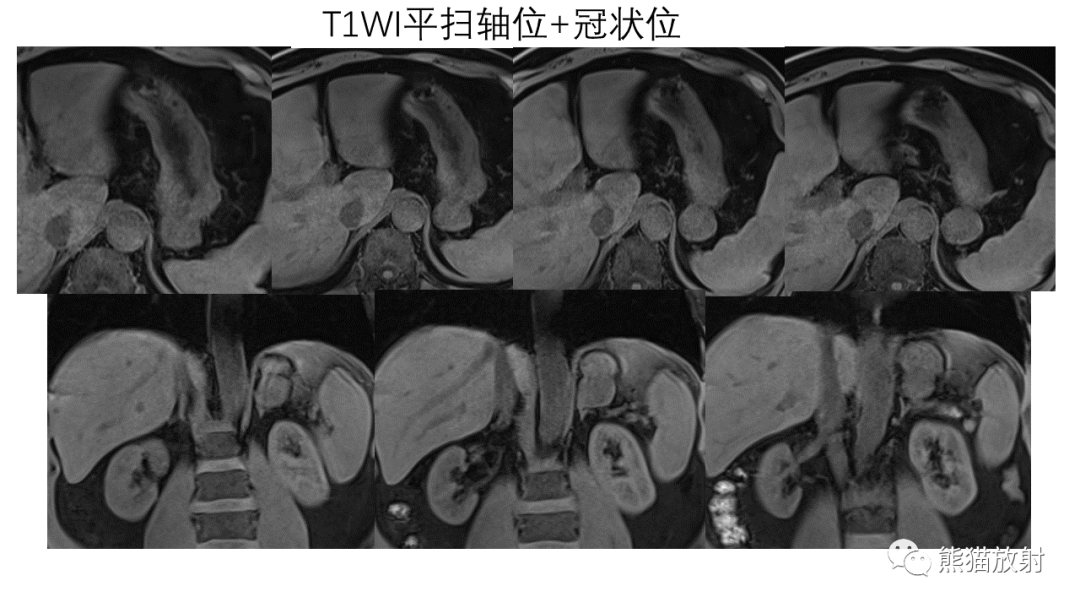 影像PPT - 【病例】异位胰腺2例CT及MR影像-9