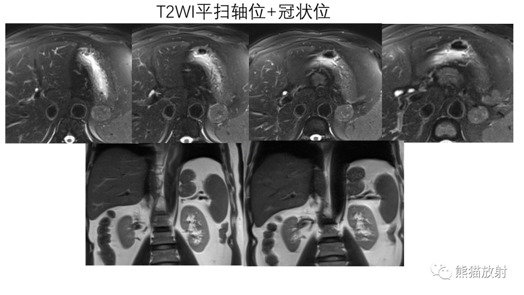 影像PPT - 【病例】异位胰腺2例CT及MR影像-10