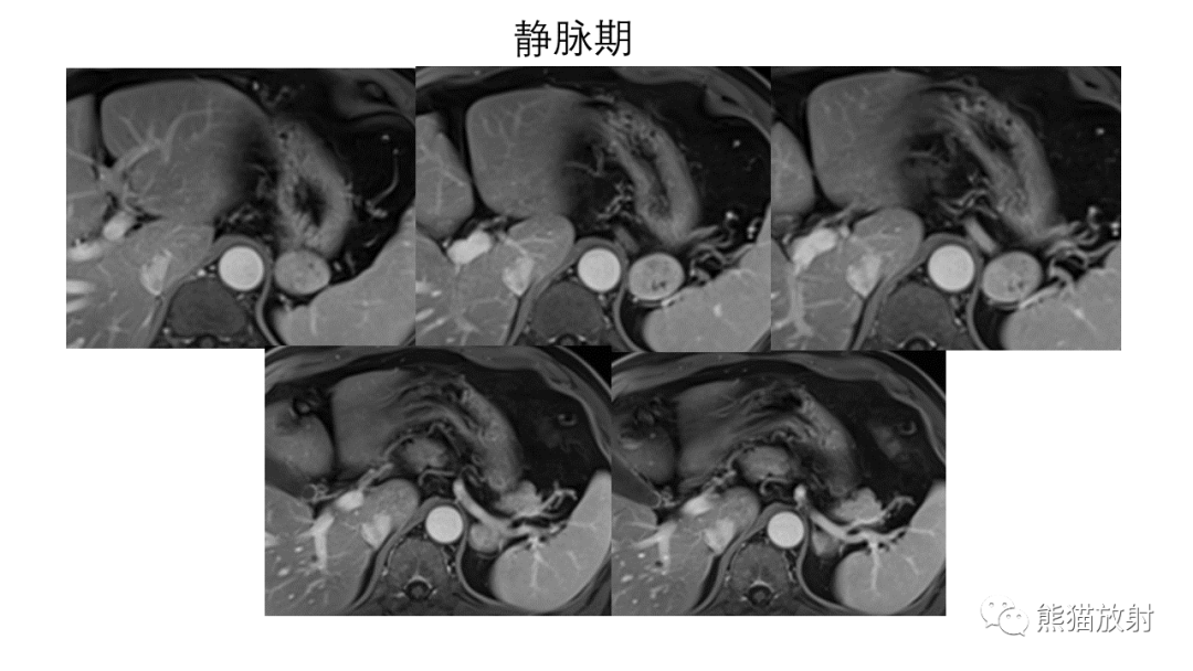 影像PPT - 【病例】异位胰腺2例CT及MR影像-13