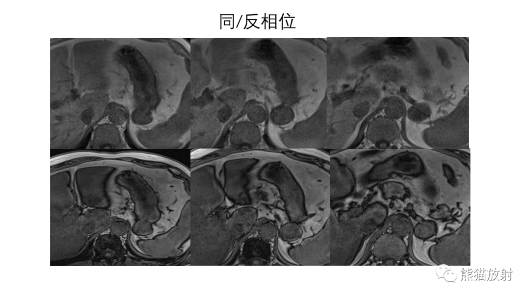 影像PPT - 【病例】异位胰腺2例CT及MR影像-11