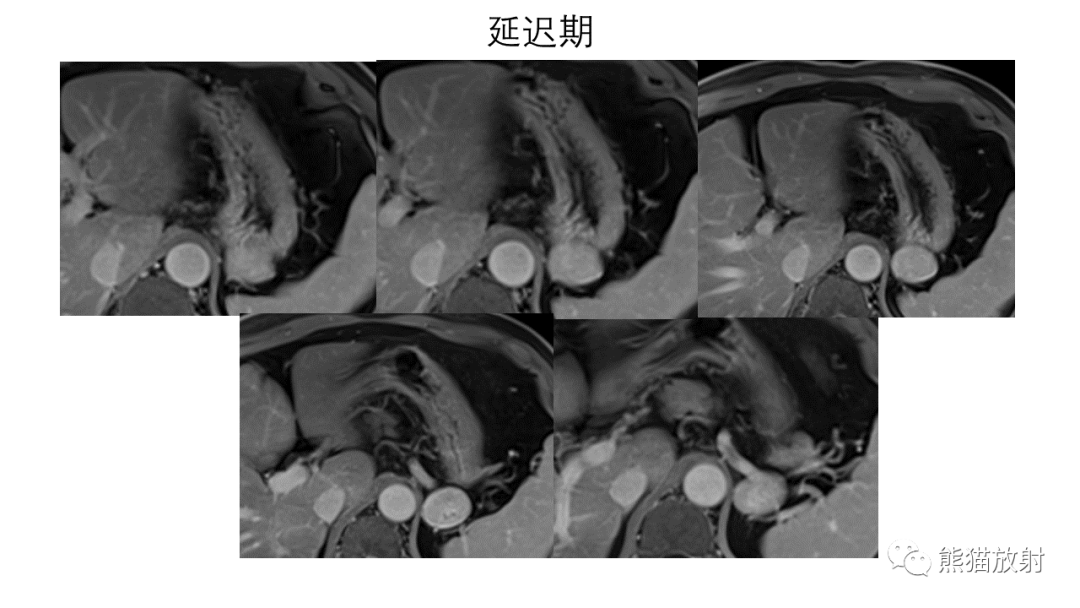 影像PPT - 【病例】异位胰腺2例CT及MR影像-14