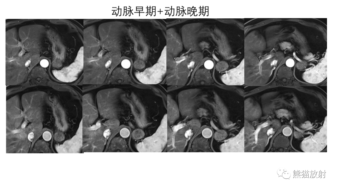 影像PPT - 【病例】异位胰腺2例CT及MR影像-12