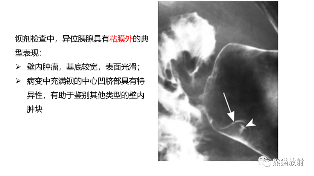 影像PPT - 【病例】异位胰腺2例CT及MR影像-24