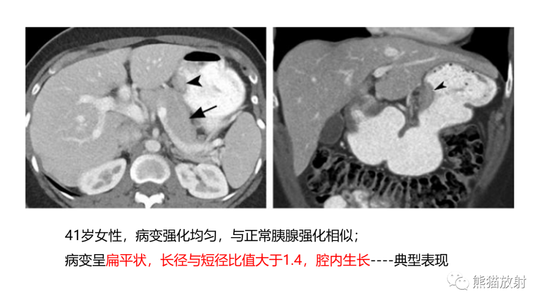 影像PPT - 【病例】异位胰腺2例CT及MR影像-27