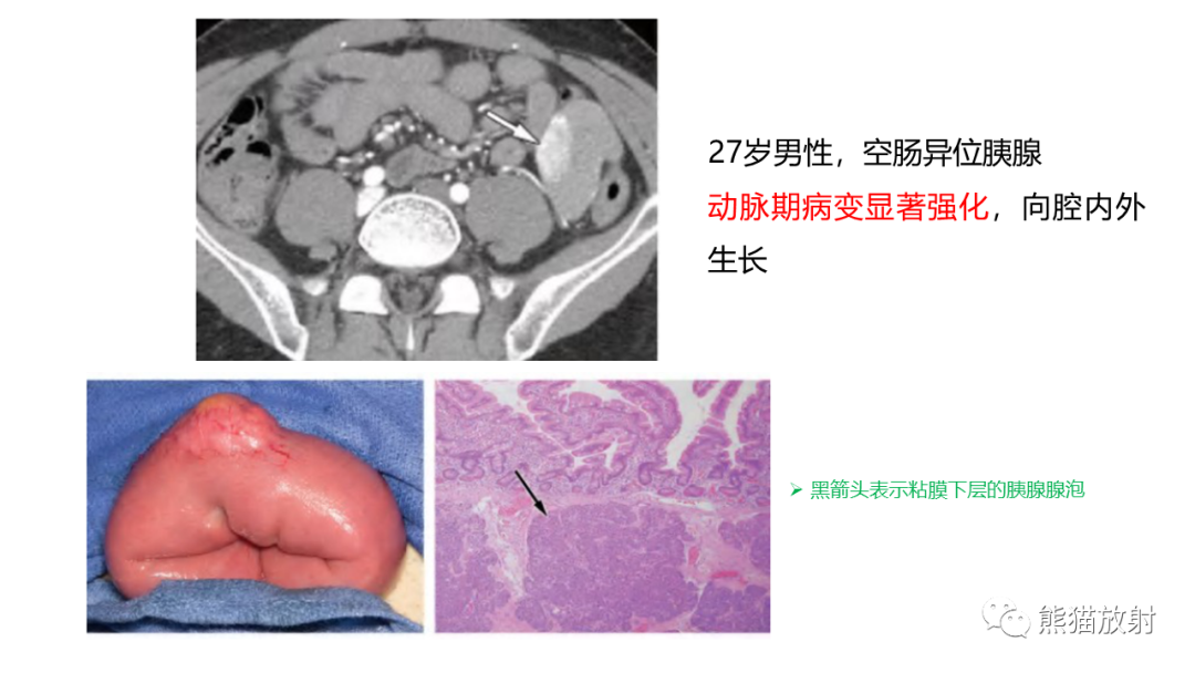 影像PPT - 【病例】异位胰腺2例CT及MR影像-28