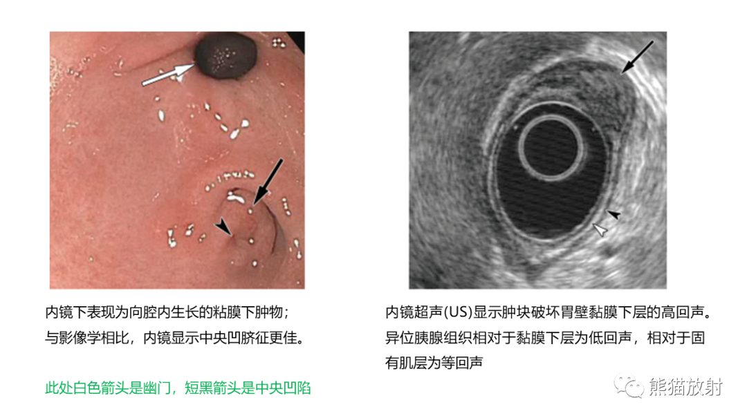 影像PPT - 【病例】异位胰腺2例CT及MR影像-25