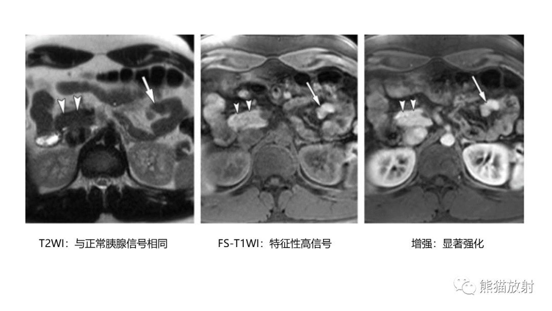影像PPT - 【病例】异位胰腺2例CT及MR影像-29