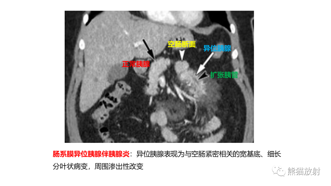 影像PPT - 【病例】异位胰腺2例CT及MR影像-30