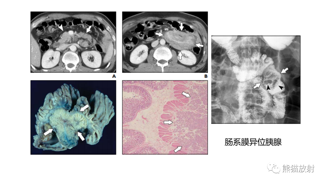 影像PPT - 【病例】异位胰腺2例CT及MR影像-31
