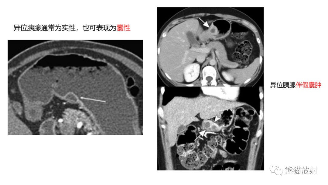 影像PPT - 【病例】异位胰腺2例CT及MR影像-32