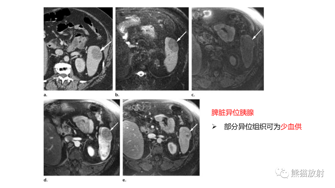 影像PPT - 【病例】异位胰腺2例CT及MR影像-33