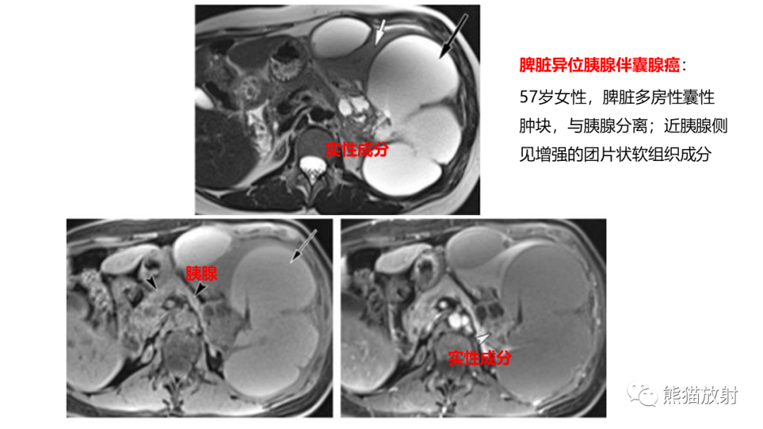 影像PPT - 【病例】异位胰腺2例CT及MR影像-34