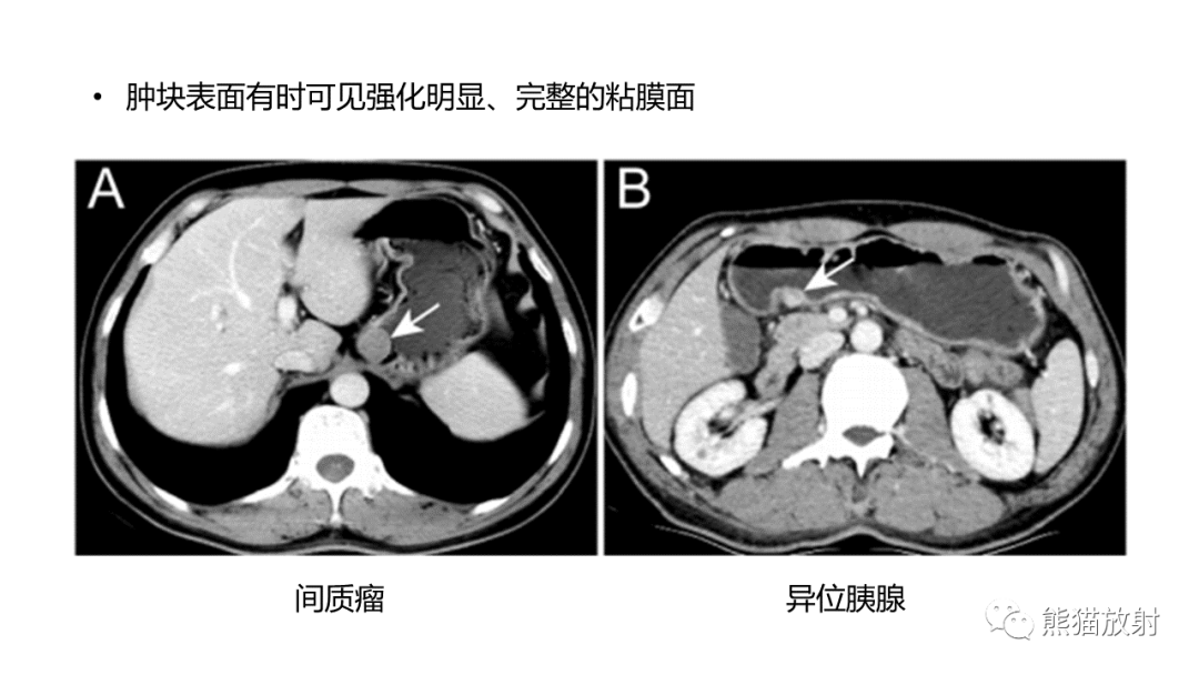 影像PPT - 【病例】异位胰腺2例CT及MR影像-37