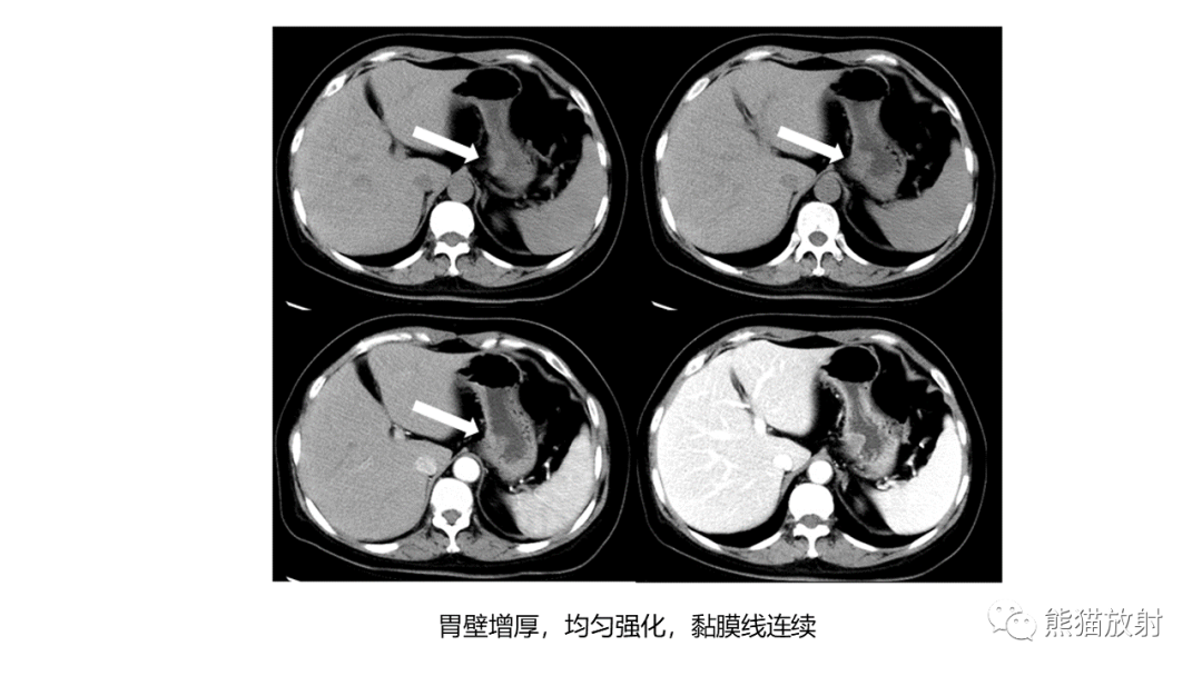 影像PPT - 【病例】异位胰腺2例CT及MR影像-41