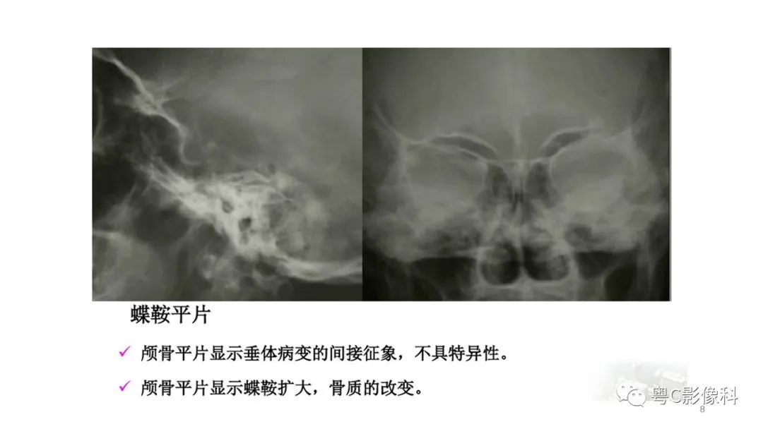 影像PPT - 【PPT】垂体的正常MR表现及儿童垂体病变的MR表现-8
