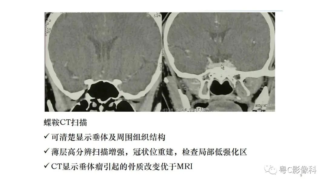影像PPT - 【PPT】垂体的正常MR表现及儿童垂体病变的MR表现-9