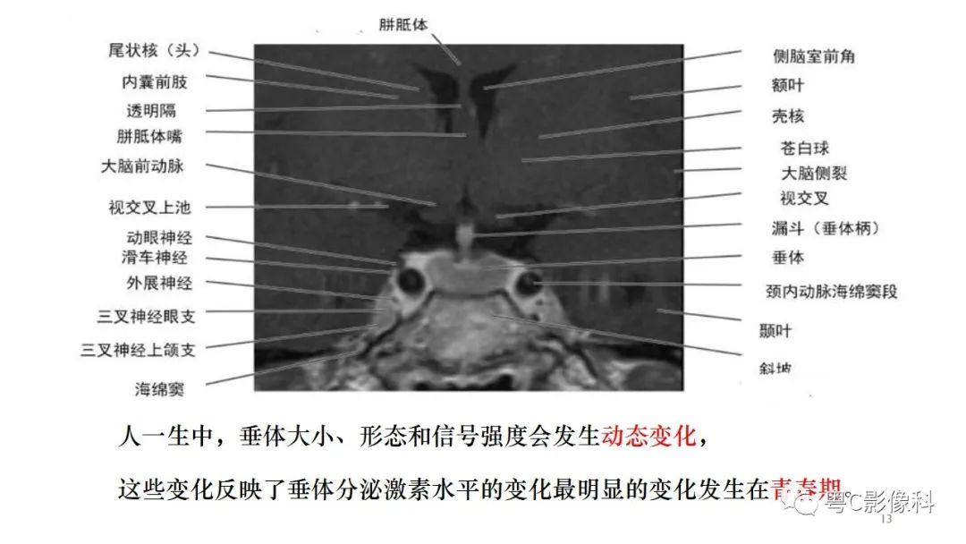 影像PPT - 【PPT】垂体的正常MR表现及儿童垂体病变的MR表现-13