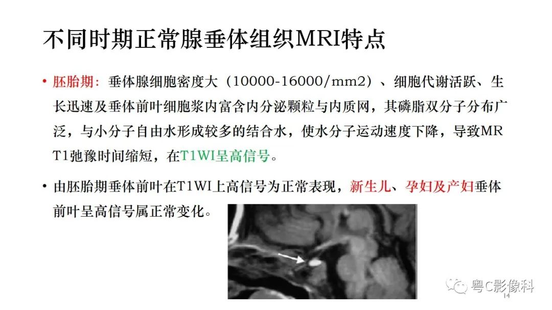 影像PPT - 【PPT】垂体的正常MR表现及儿童垂体病变的MR表现-14