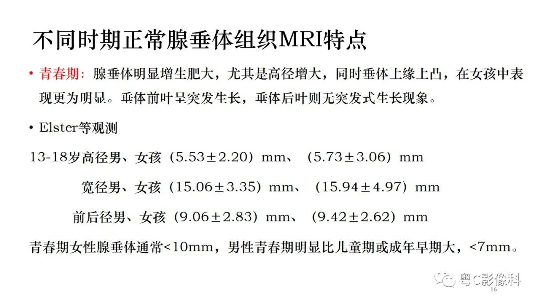 影像PPT - 【PPT】垂体的正常MR表现及儿童垂体病变的MR表现-16