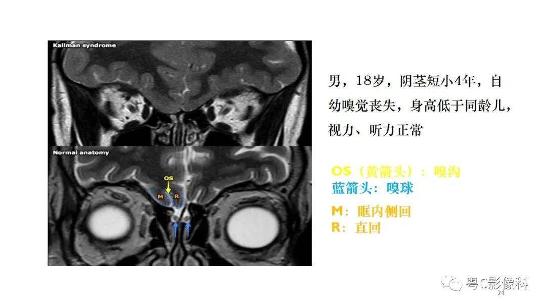 影像PPT - 【PPT】垂体的正常MR表现及儿童垂体病变的MR表现-24
