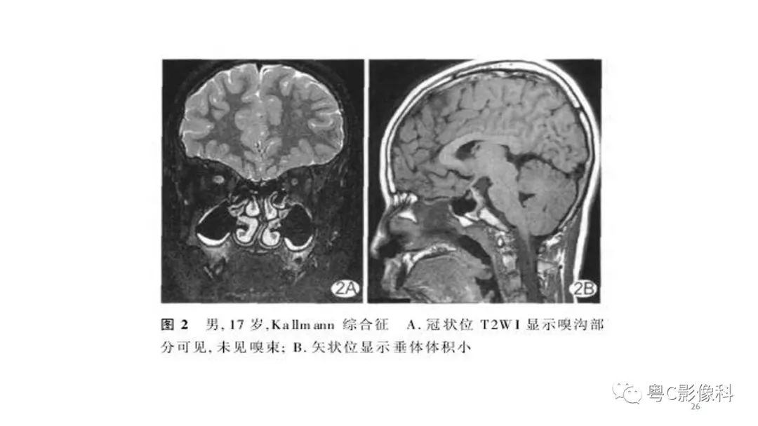 影像PPT - 【PPT】垂体的正常MR表现及儿童垂体病变的MR表现-26