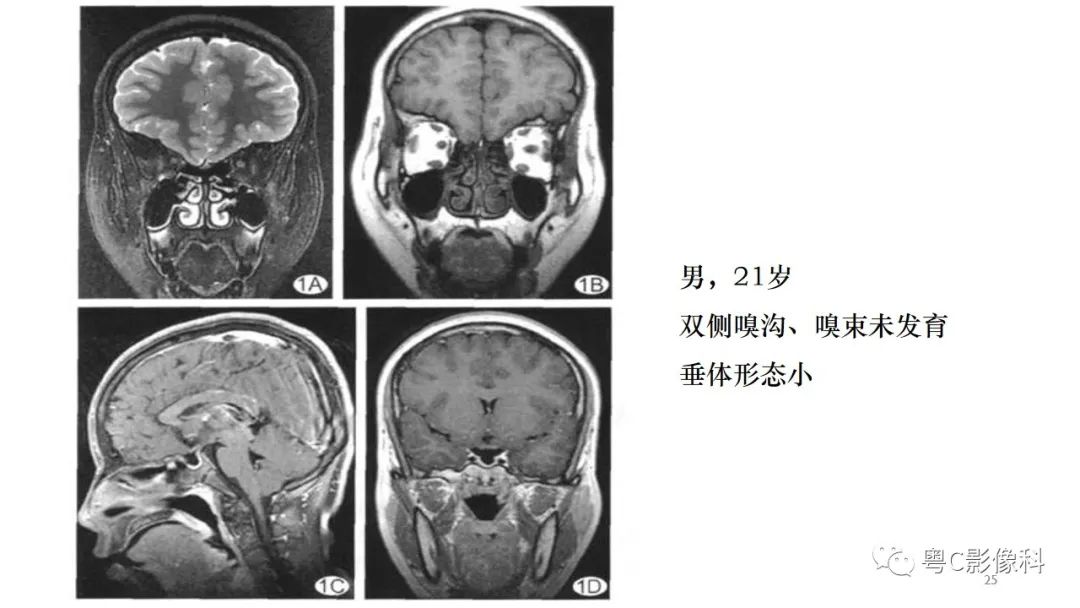 影像PPT - 【PPT】垂体的正常MR表现及儿童垂体病变的MR表现-25