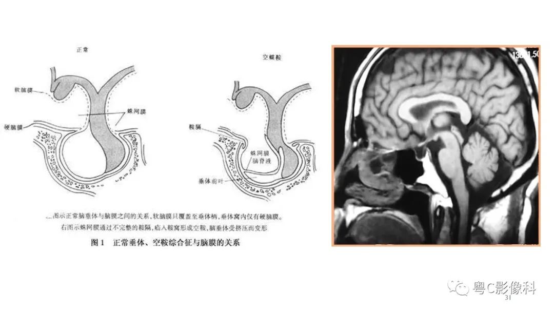影像PPT - 【PPT】垂体的正常MR表现及儿童垂体病变的MR表现-31