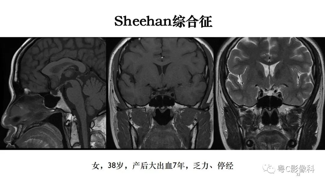 影像PPT - 【PPT】垂体的正常MR表现及儿童垂体病变的MR表现-32