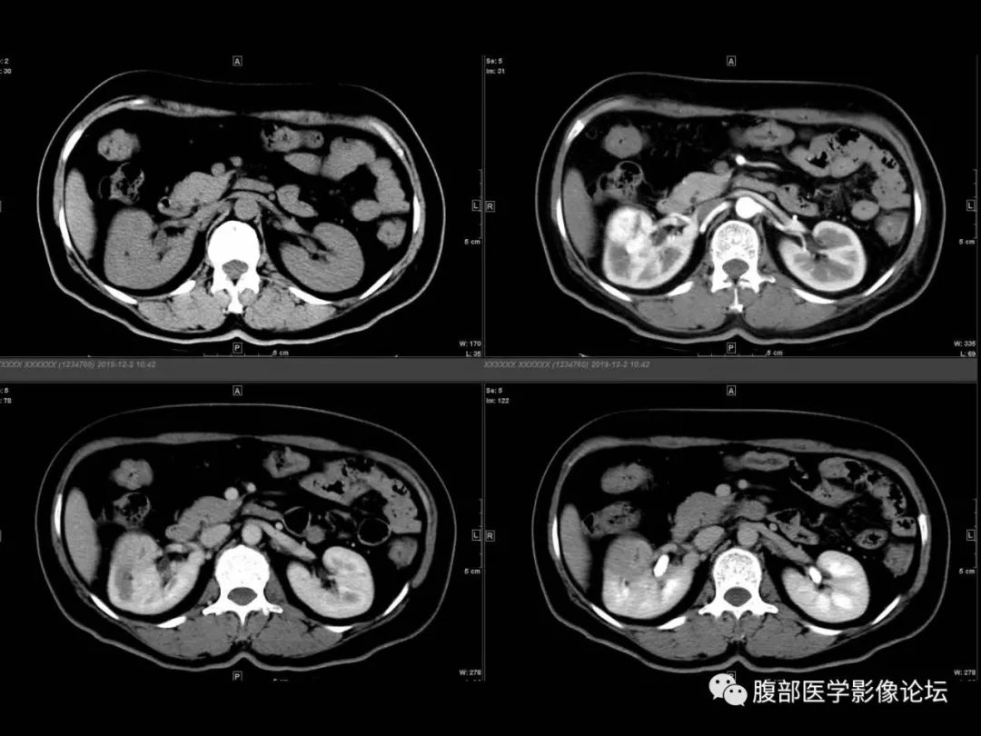 影像PPT - 【病例】肾脏透明细胞癌1例CT影像-2