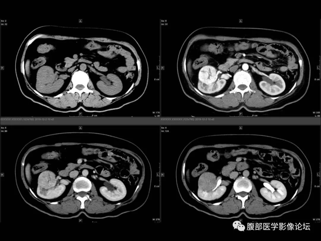影像PPT - 【病例】肾脏透明细胞癌1例CT影像-4