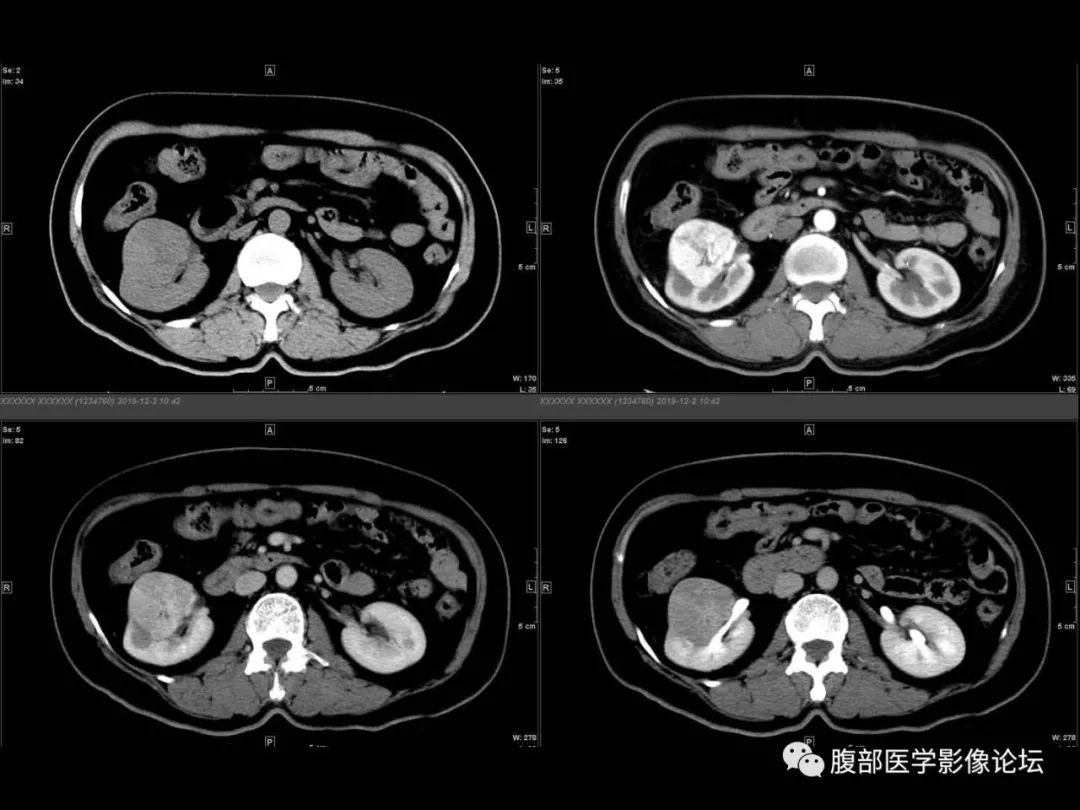 影像PPT - 【病例】肾脏透明细胞癌1例CT影像-6