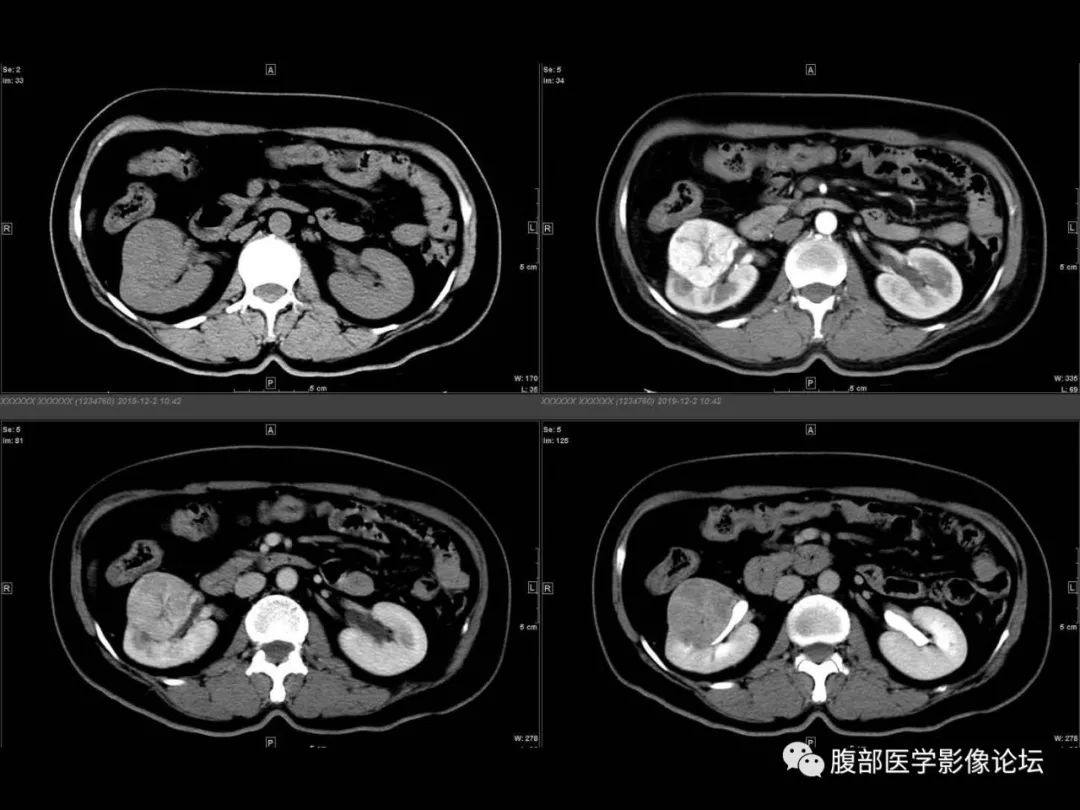 影像PPT - 【病例】肾脏透明细胞癌1例CT影像-5