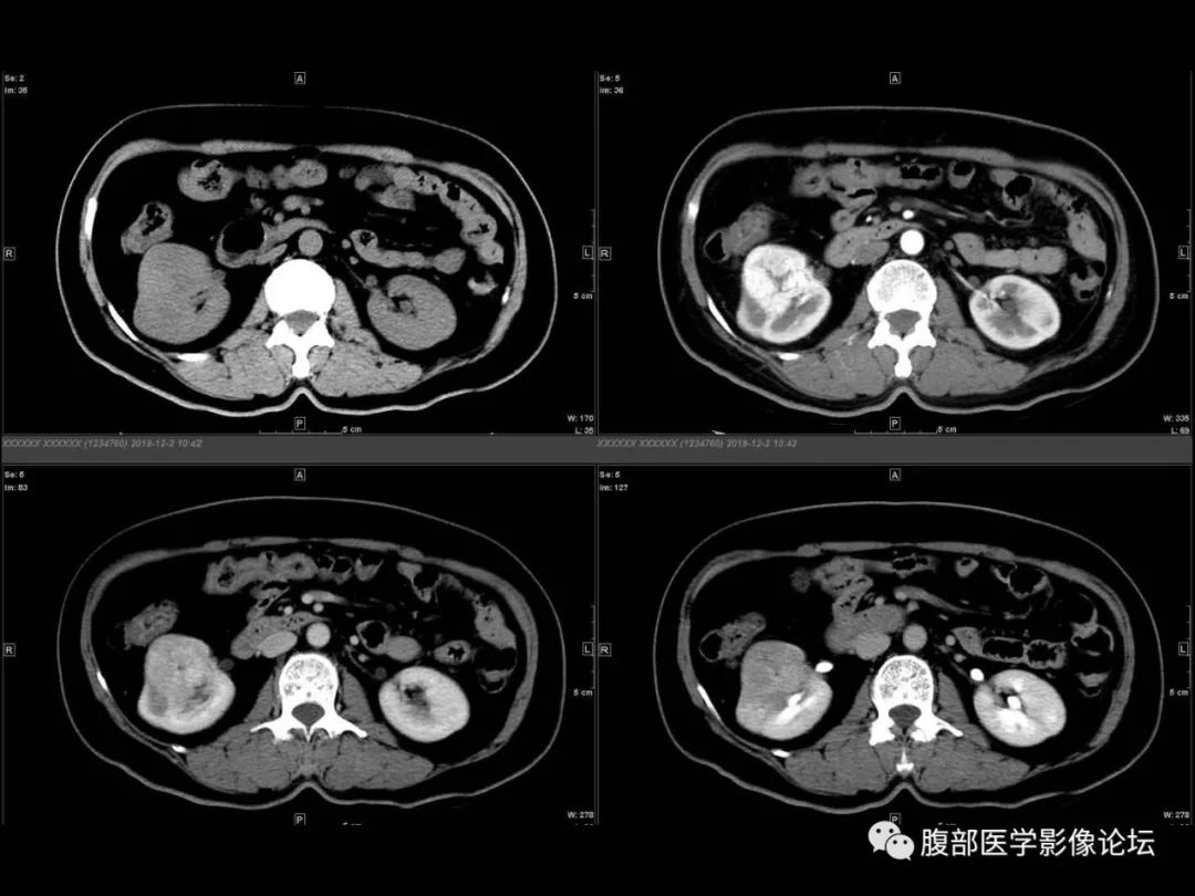 影像PPT - 【病例】肾脏透明细胞癌1例CT影像-7
