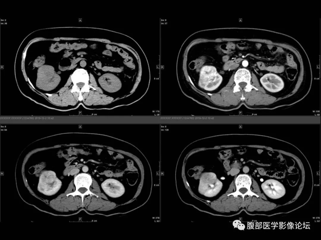 影像PPT - 【病例】肾脏透明细胞癌1例CT影像-8