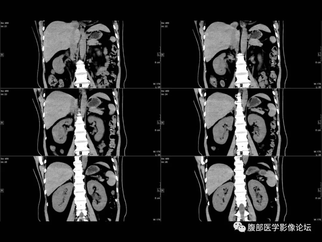 影像PPT - 【病例】肾脏透明细胞癌1例CT影像-10
