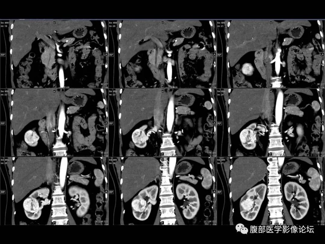 影像PPT - 【病例】肾脏透明细胞癌1例CT影像-12