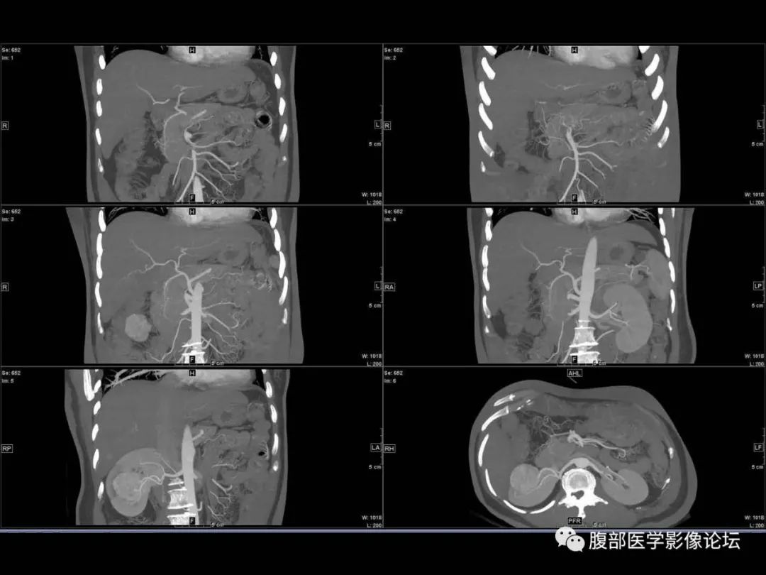 影像PPT - 【病例】肾脏透明细胞癌1例CT影像-11