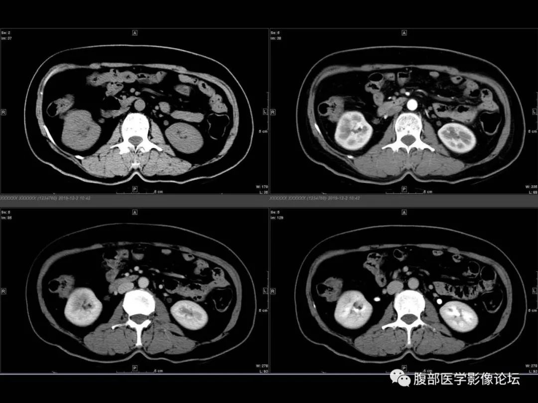 影像PPT - 【病例】肾脏透明细胞癌1例CT影像-9